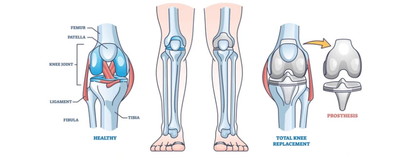 Knee Replacement