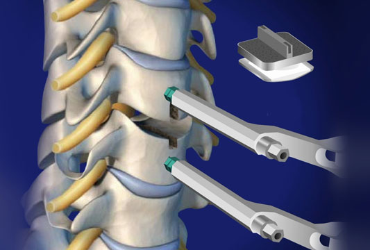 Cervical Disc Replacement Surgery