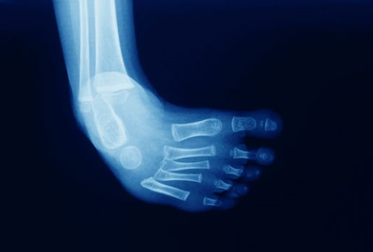 Congenital & Developmental Bone Disorders