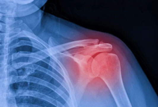 Shoulder Ligament Tear