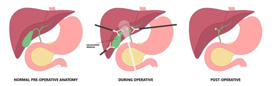 Gallbladder Stones