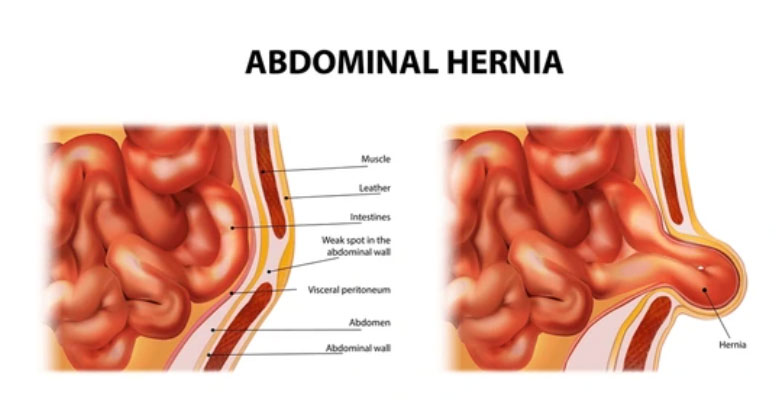 Hernia